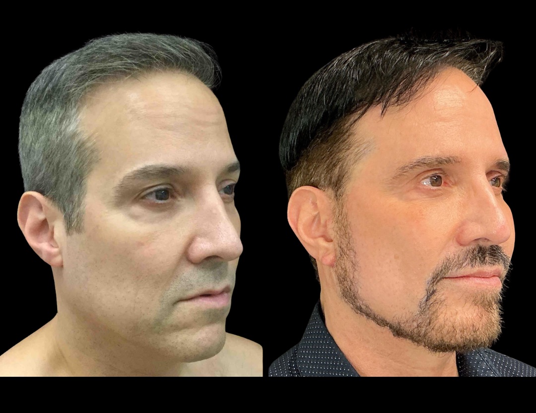 Copy of 37761 tummy tuck female before and after – 4