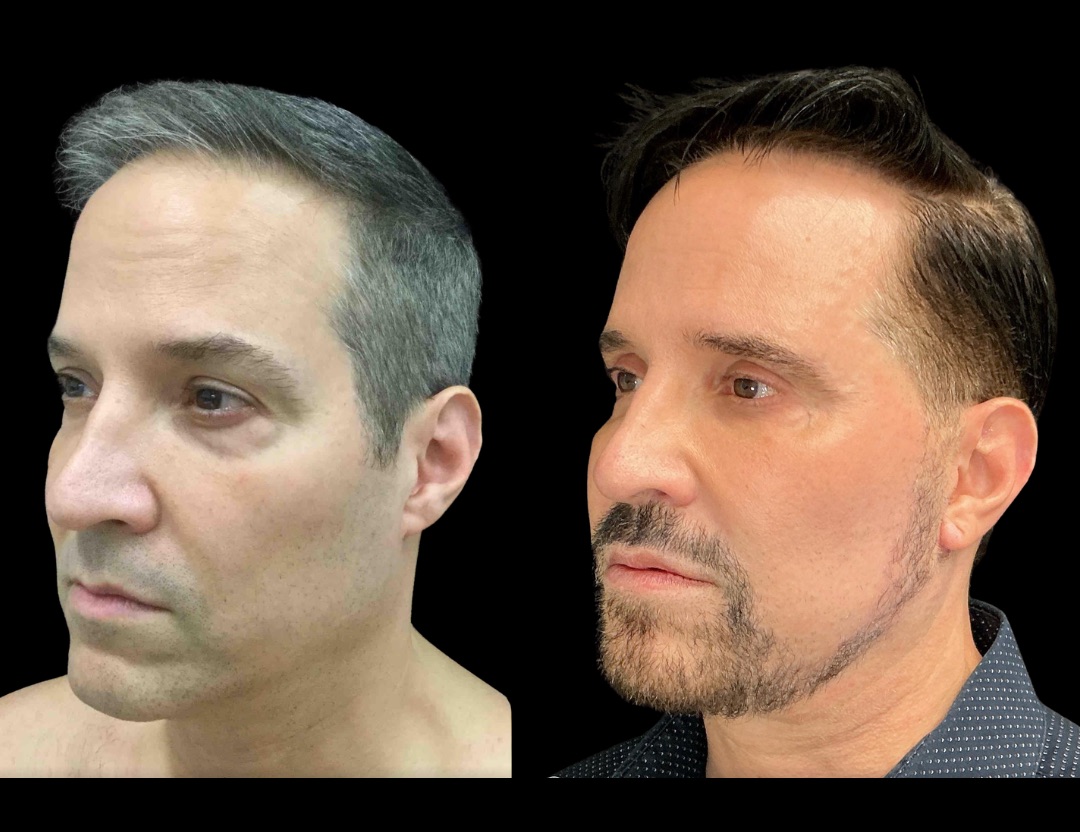 Copy of 37761 tummy tuck female before and after – 5