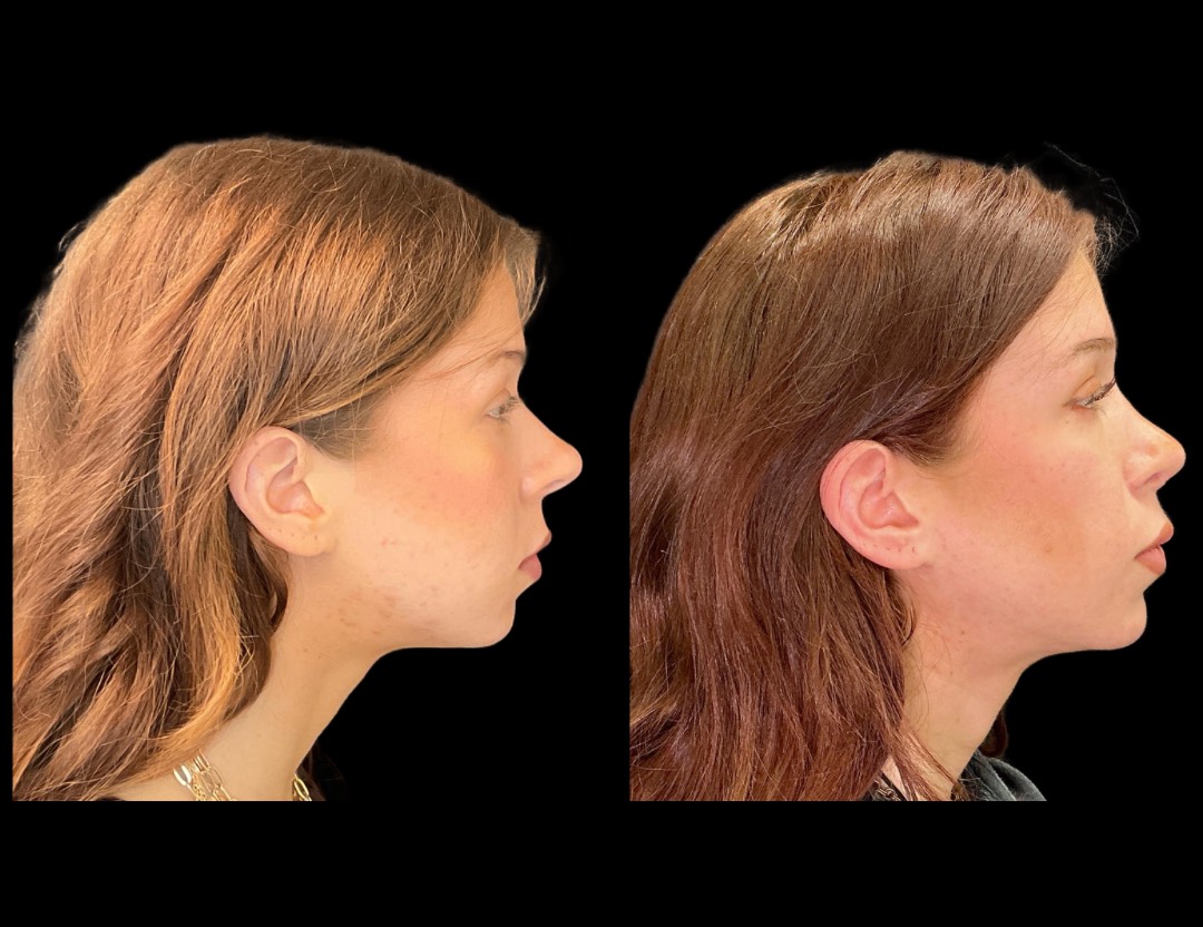 Copy of 5818 Blenheim female before and after – 5