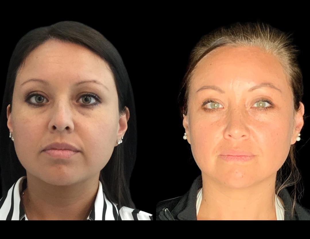 20249 rhino female before and after – 1