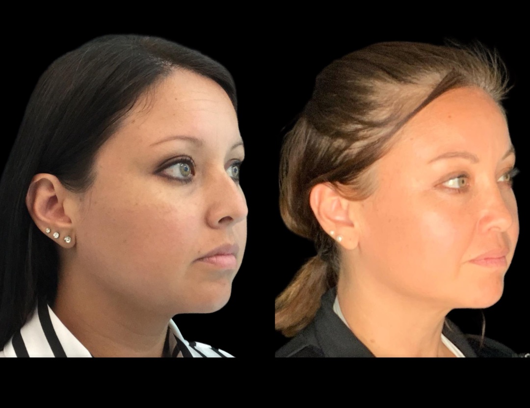 20249 rhino female before and after – 2