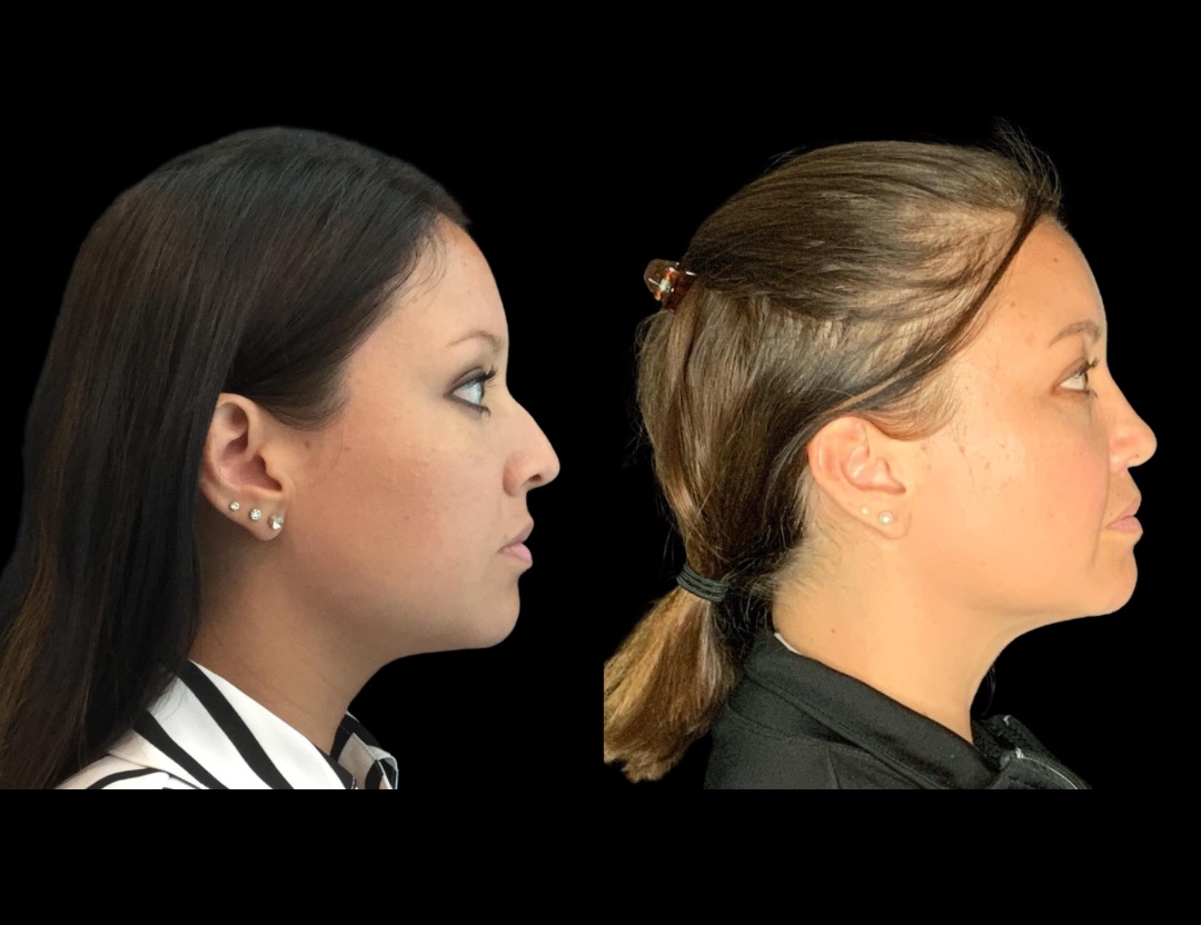 20249 rhino female before and after – 3