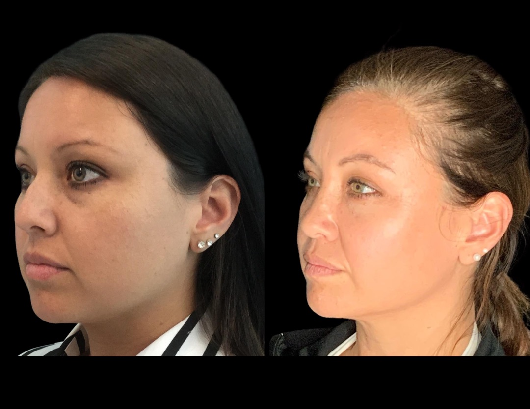 20249 rhino female before and after – 4