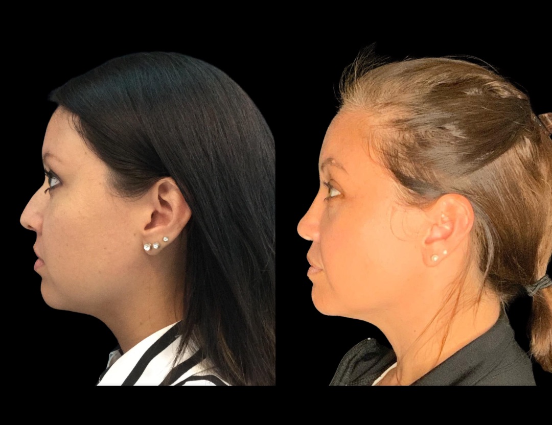 20249 rhino female before and after – 5