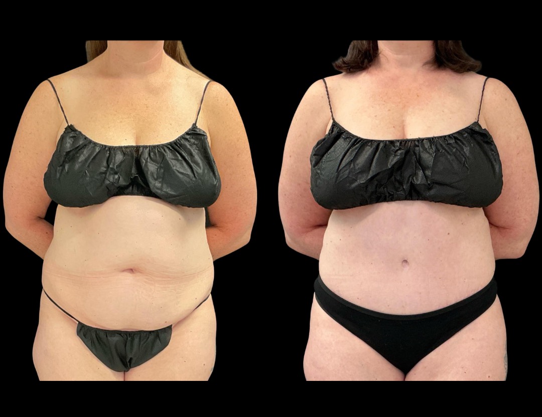 999 tummy tuck female before and after – 1