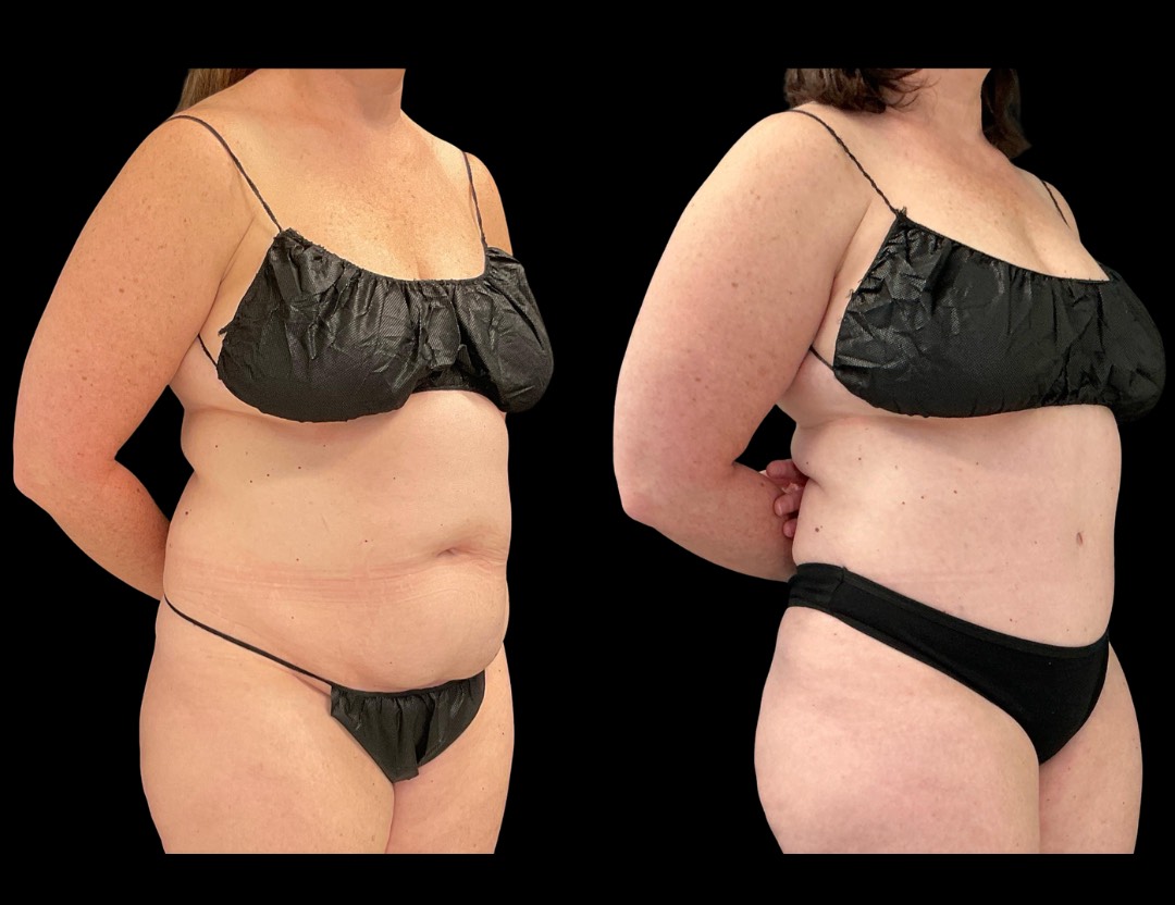 999 tummy tuck female before and after – 2