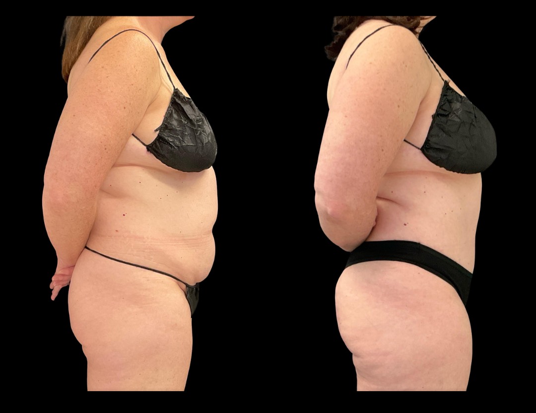 999 tummy tuck female before and after – 3