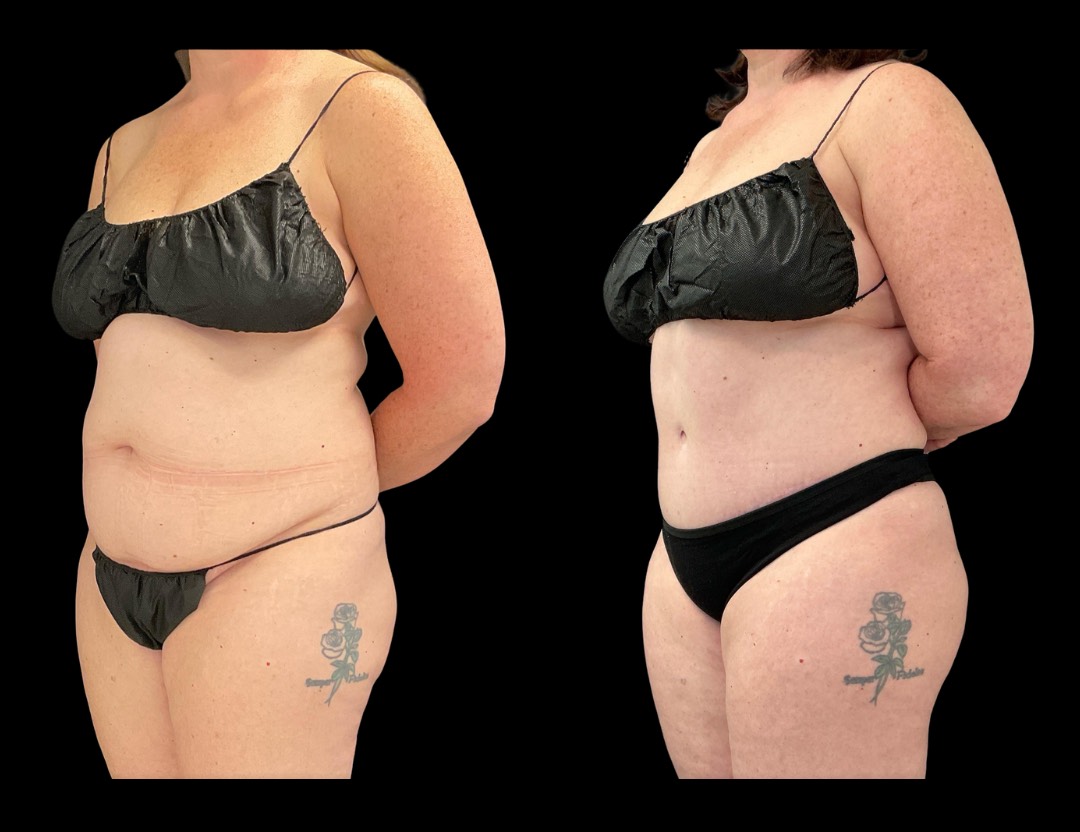 999 tummy tuck female before and after – 4