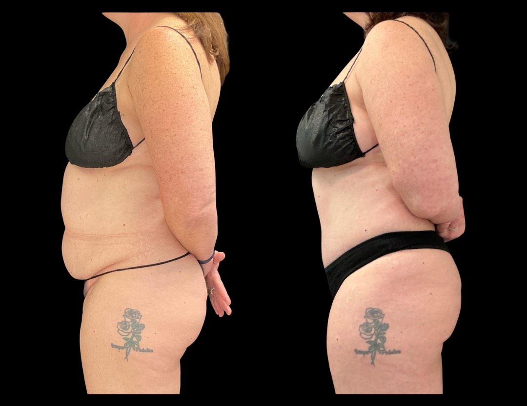 999 tummy tuck female before and after – 5