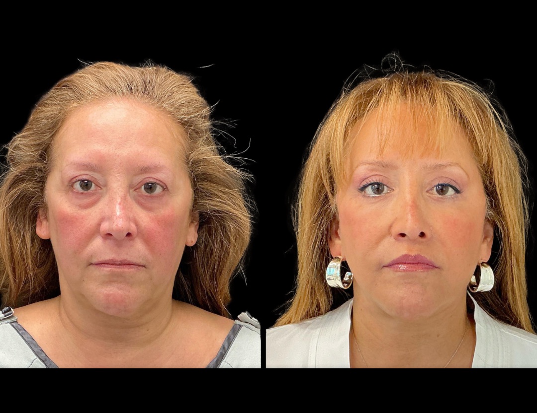 Copy of 20249 rhino female before and after – 1