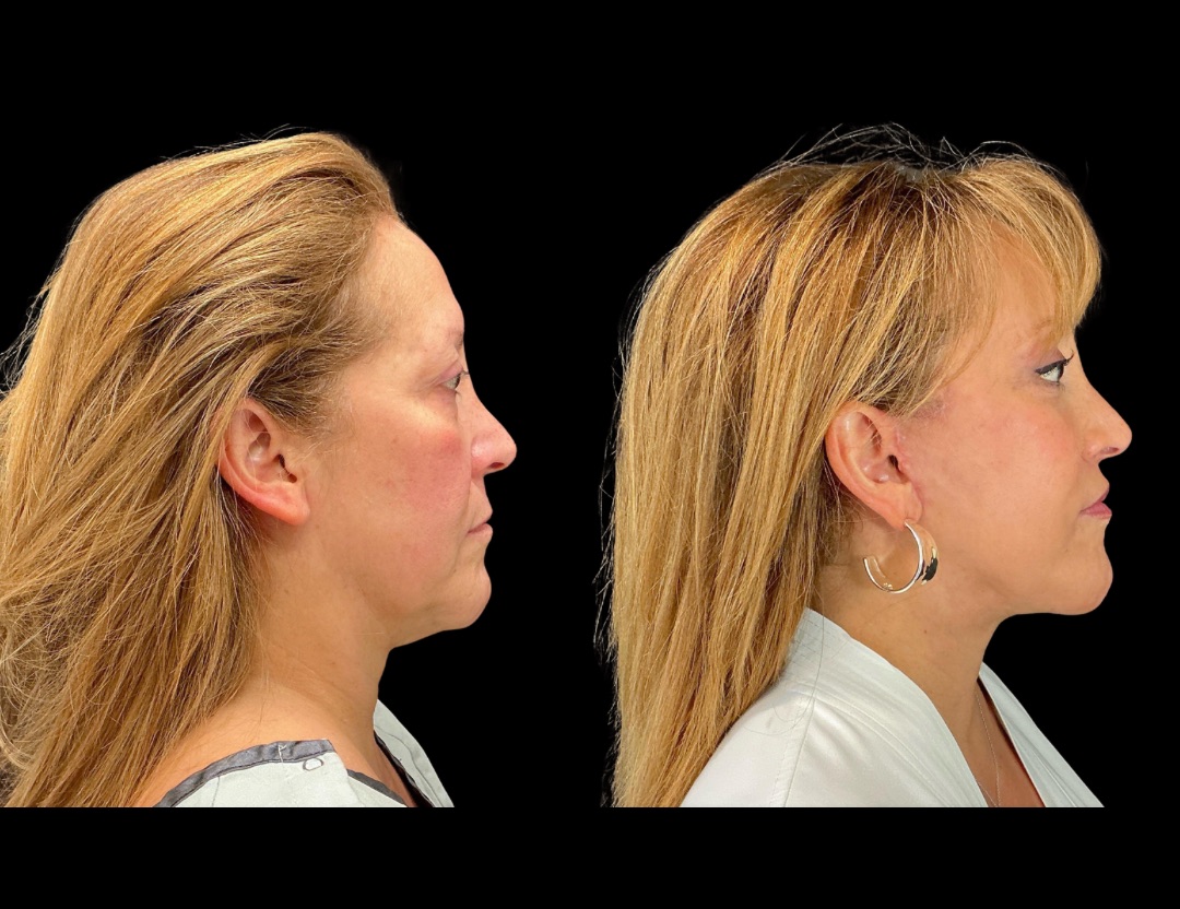Copy of 20249 rhino female before and after – 2