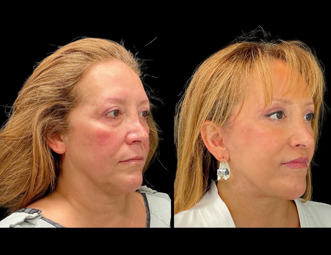 Copy of 20249 rhino female before and after – 3