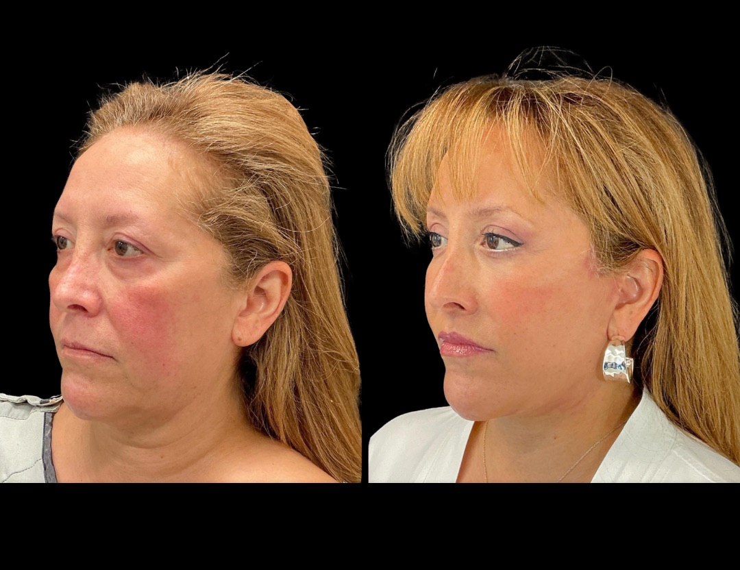 Copy of 20249 rhino female before and after – 4