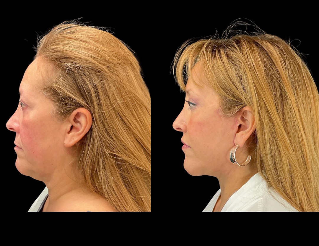Copy of 20249 rhino female before and after – 5