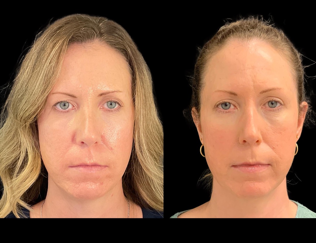 Copy of 24811 face,necklift female before and after – 1