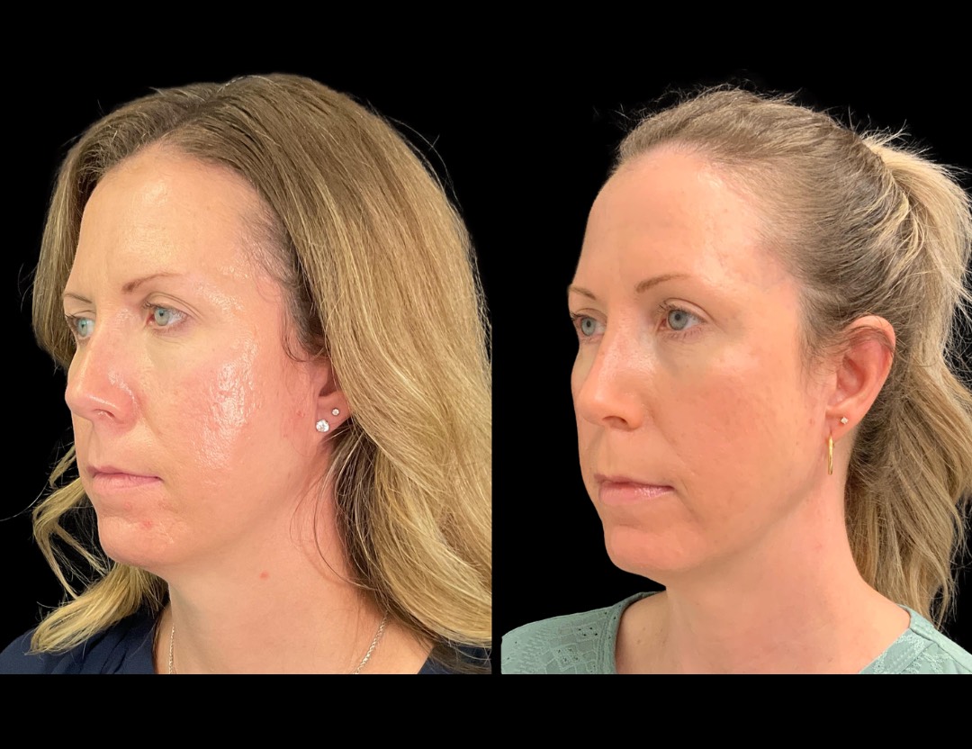Copy of 24811 face,necklift female before and after – 2
