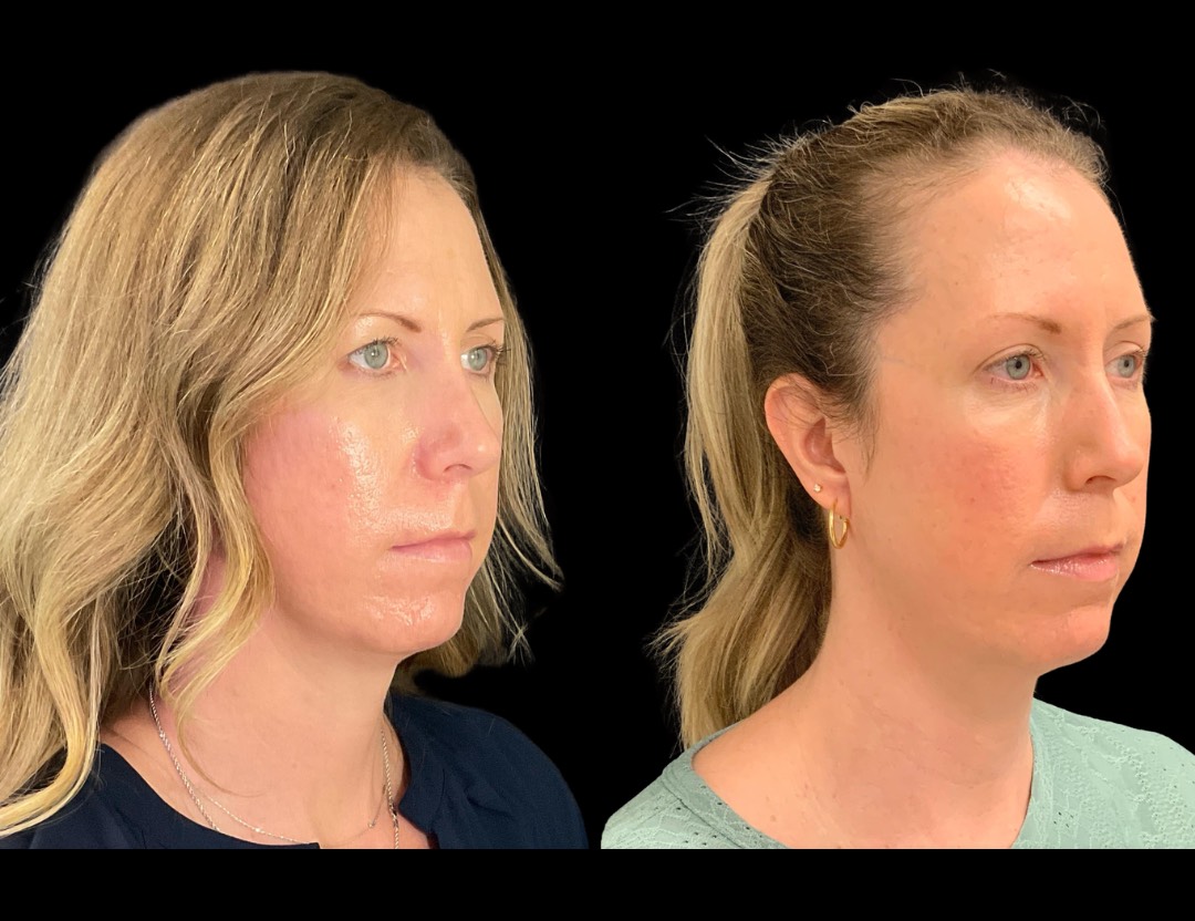 Copy of 24811 face,necklift female before and after – 3