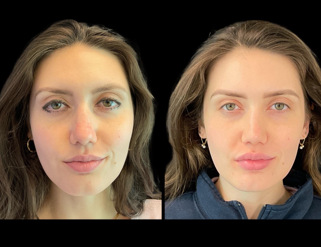 Copy of 31037 rhino female before and after – 1