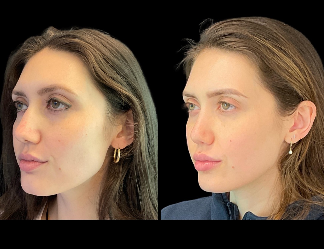 Copy of 31037 rhino female before and after – 2