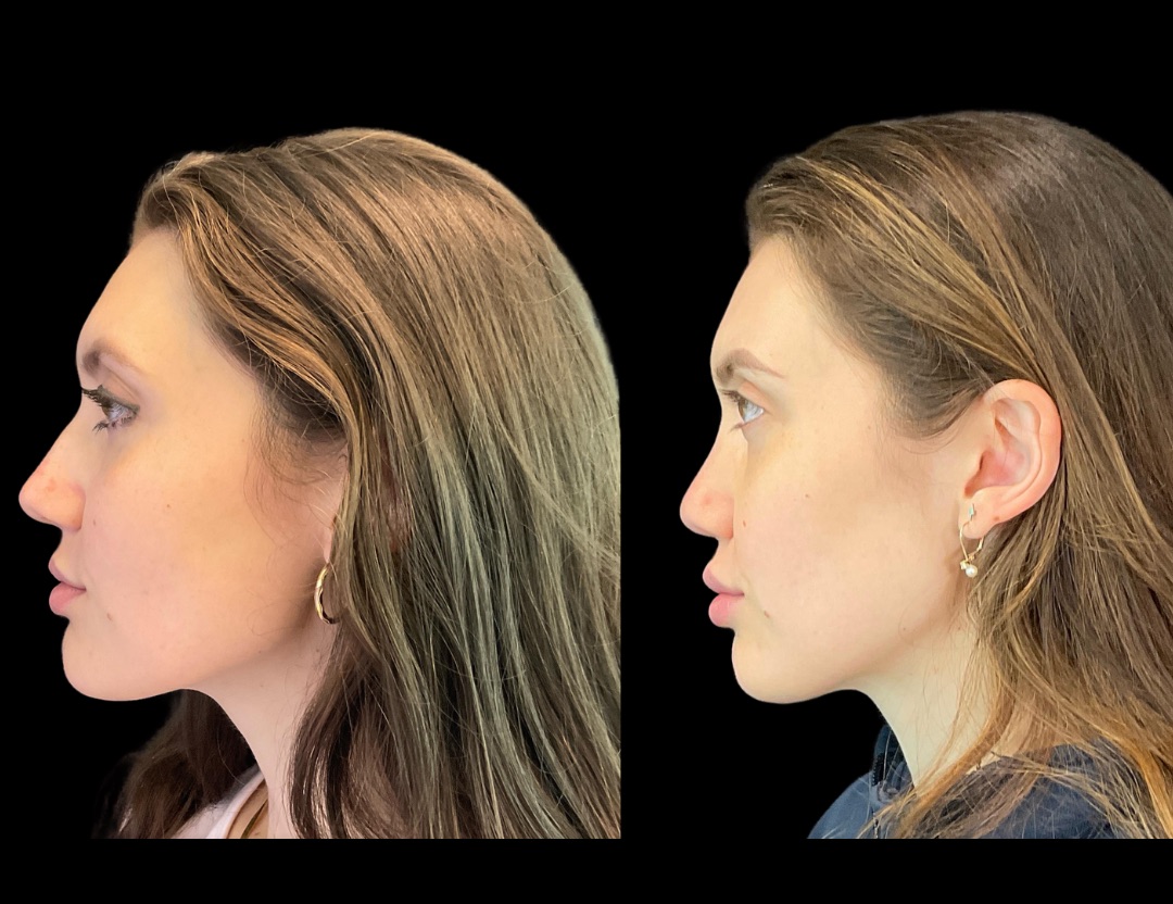 Copy of 31037 rhino female before and after – 3