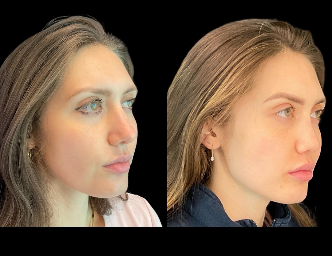 Copy of 31037 rhino female before and after – 4