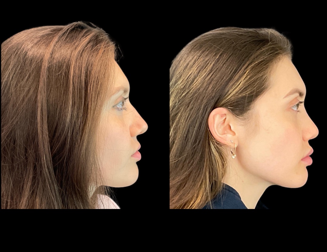 Copy of 31037 rhino female before and after – 5