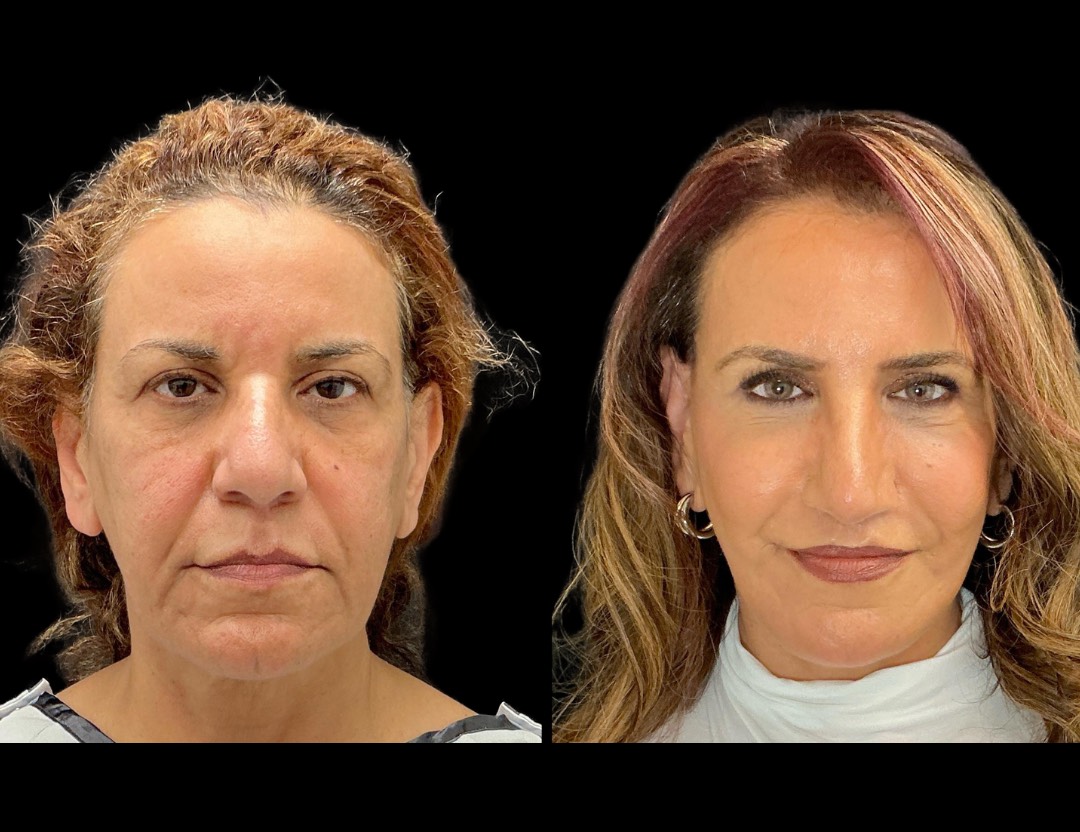 Copy of 35001 facelift female before and after – 1