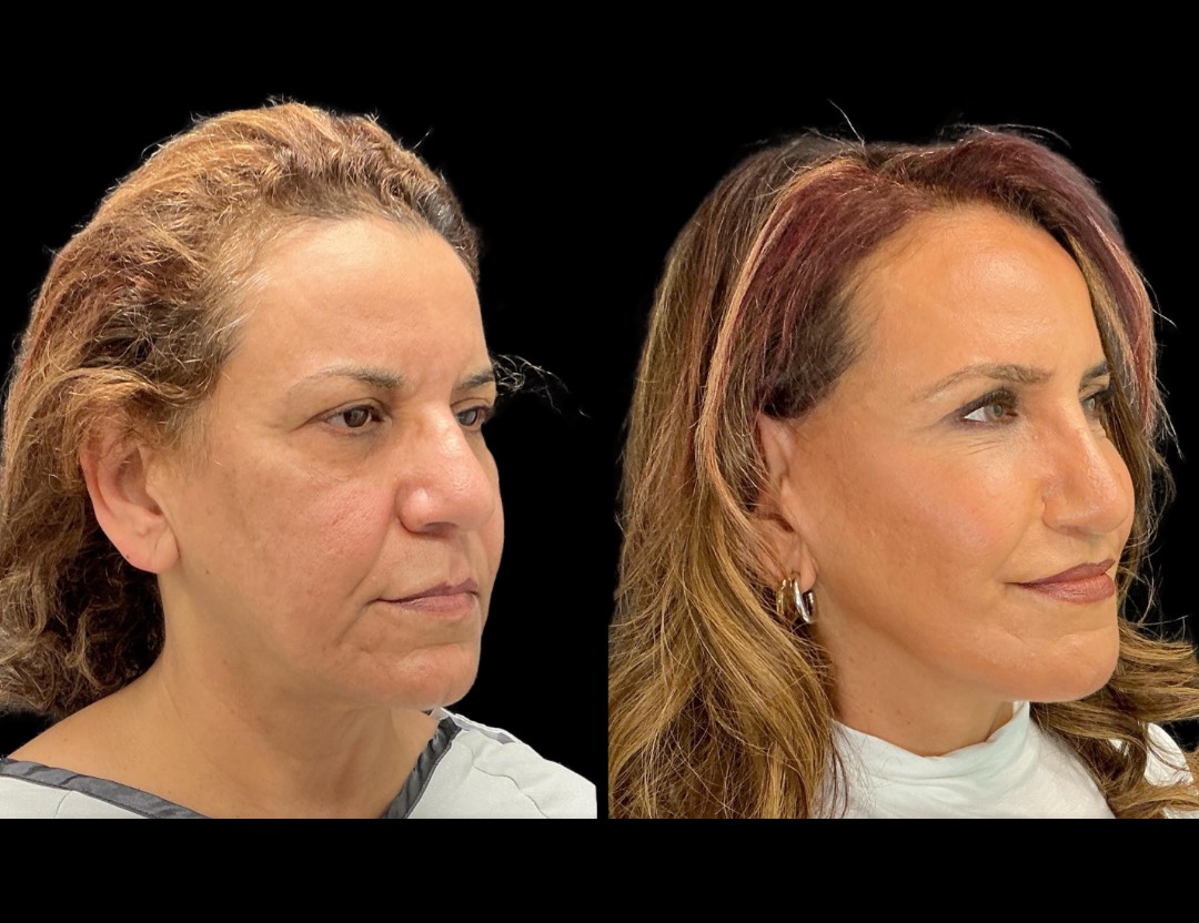Copy of 35001 facelift female before and after – 2