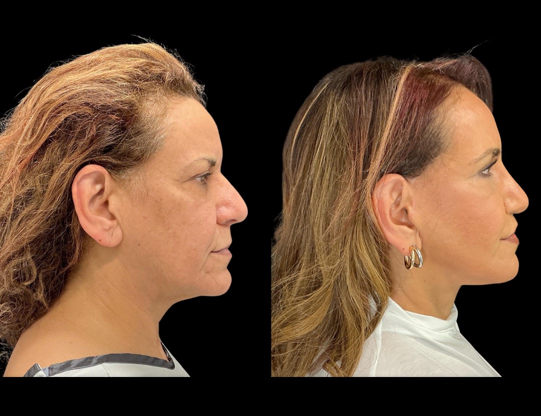 Copy of 35001 facelift female before and after – 3