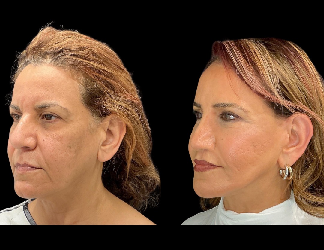Copy of 35001 facelift female before and after – 4