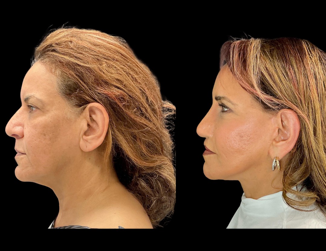 Copy of 35001 facelift female before and after – 5