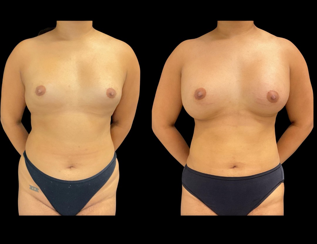 Copy of Copy of 24811 face,necklift female before and after – 1