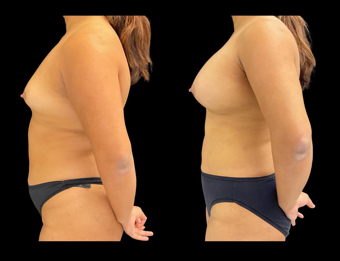Copy of Copy of 24811 face,necklift female before and after – 2