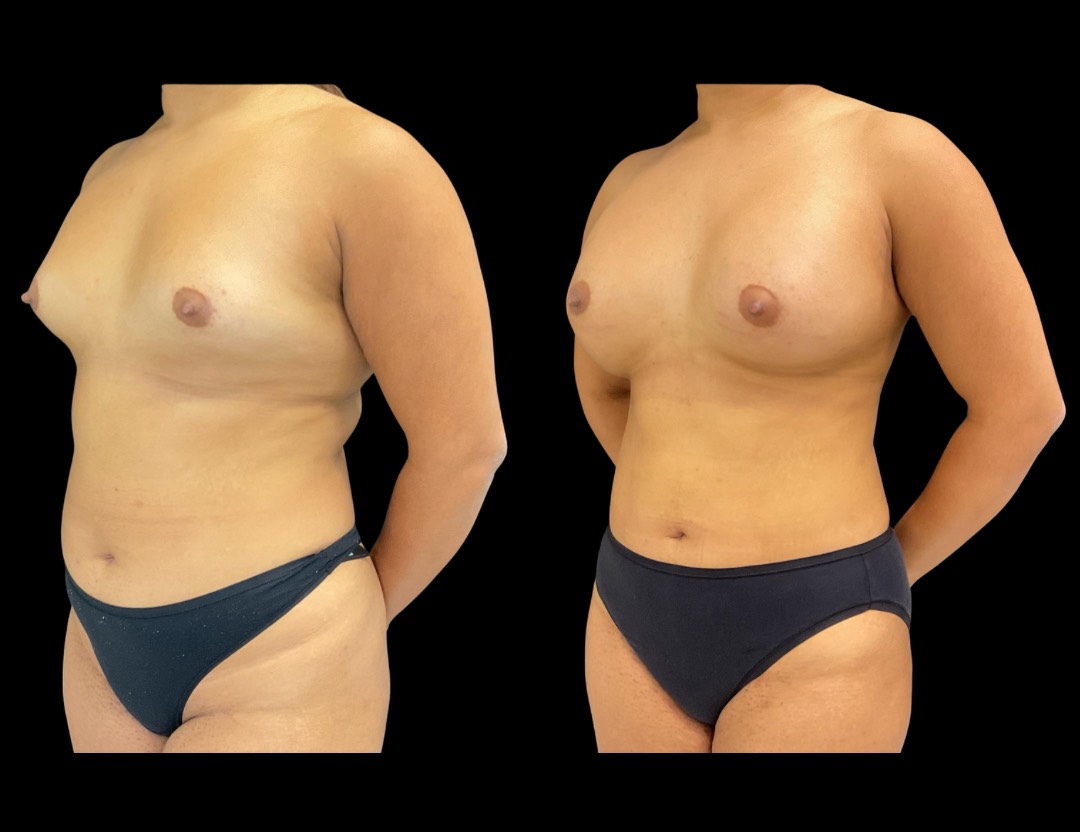 Copy of Copy of 24811 face,necklift female before and after – 3