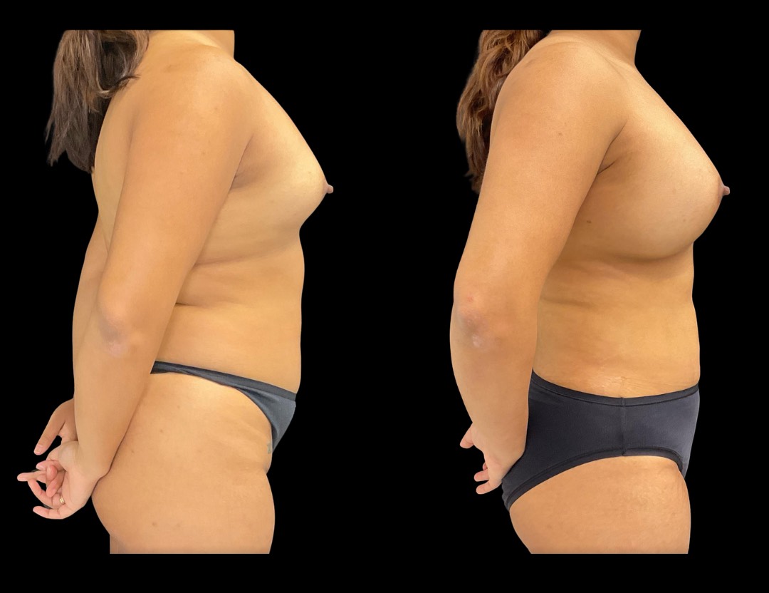 Copy of Copy of 24811 face,necklift female before and after – 4