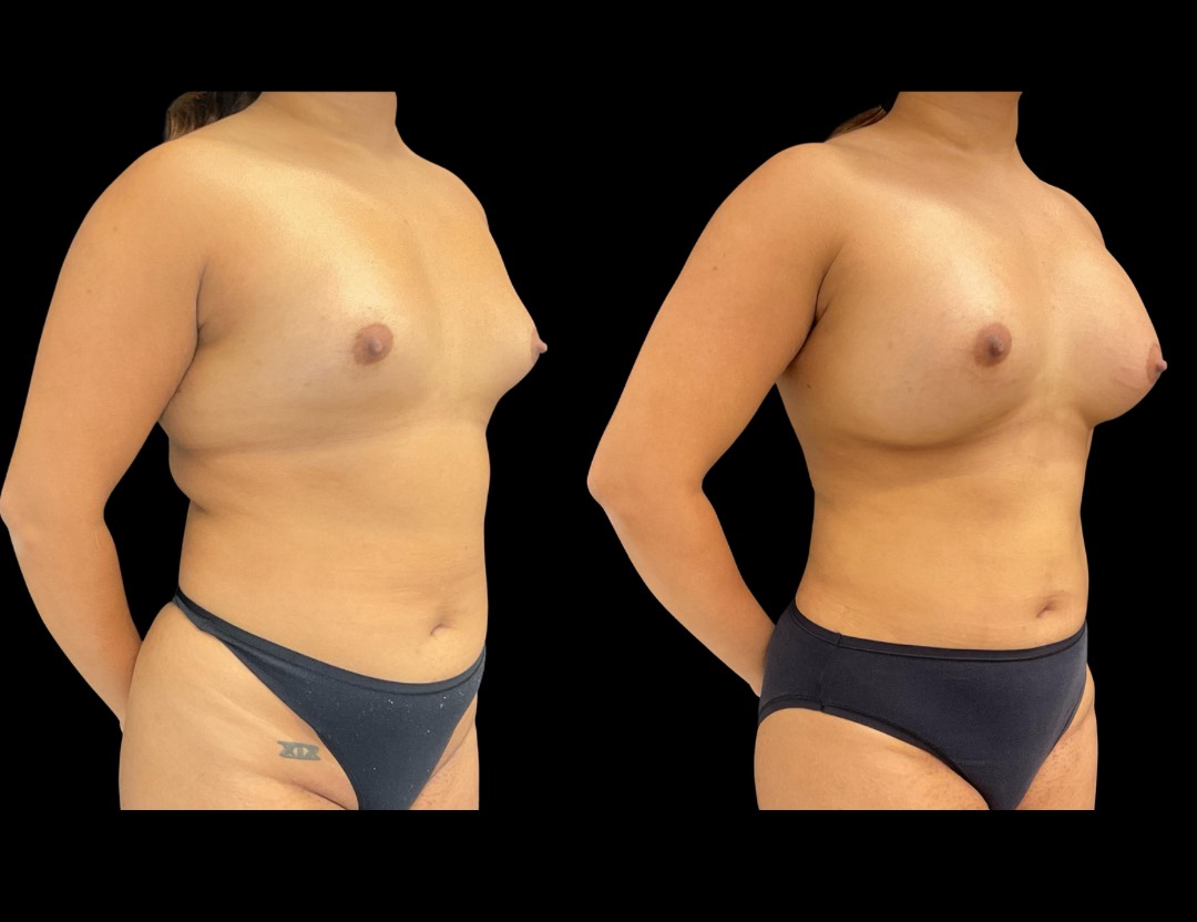 Copy of Copy of 24811 face,necklift female before and after – 5