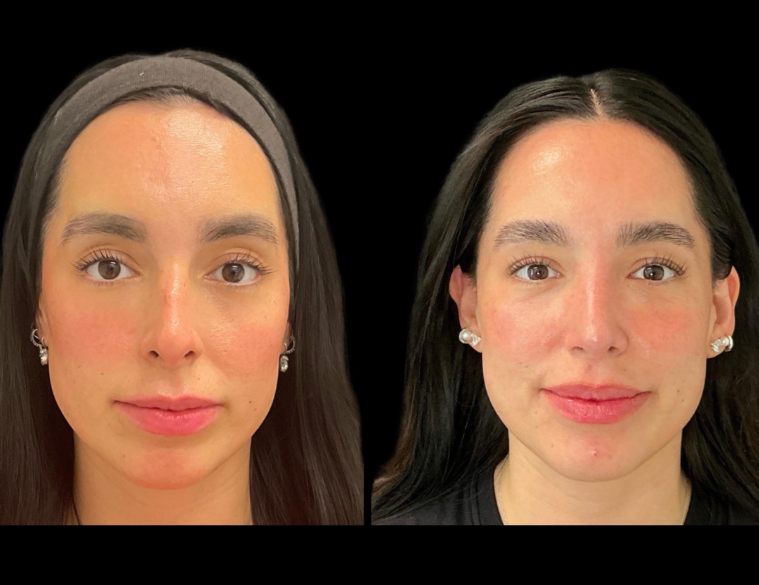 Copy of Copy of 37862 rhino female before and after – 1