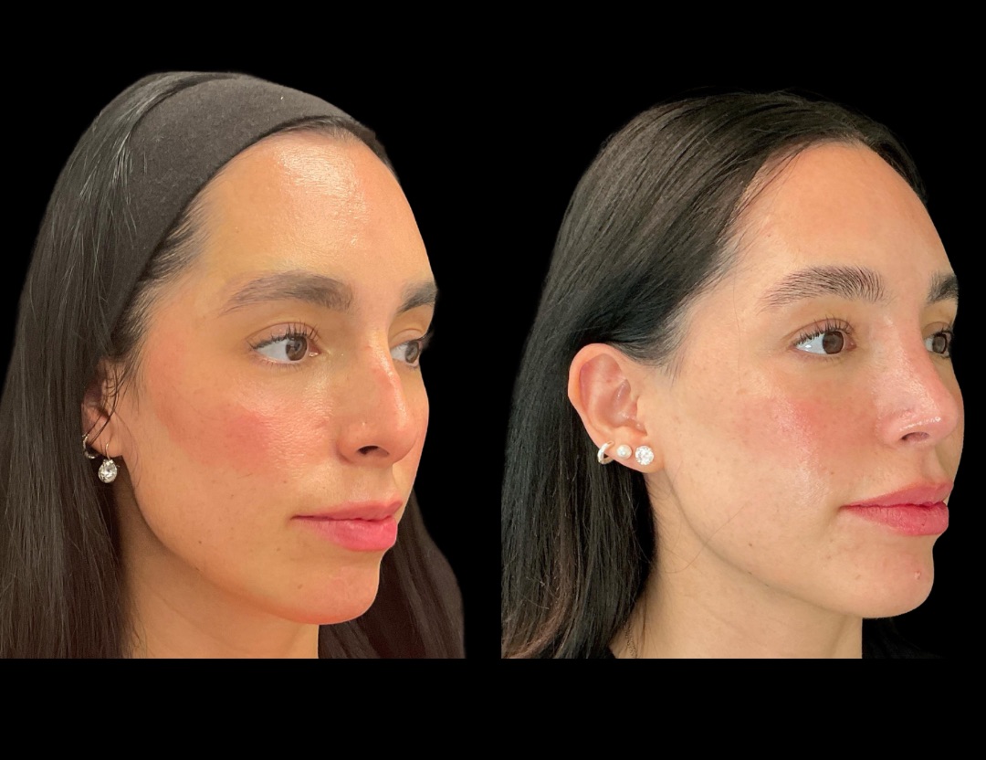 Copy of Copy of 37862 rhino female before and after – 2