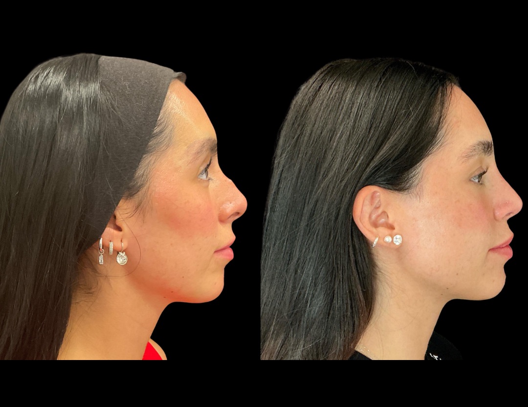 Copy of Copy of 37862 rhino female before and after – 3
