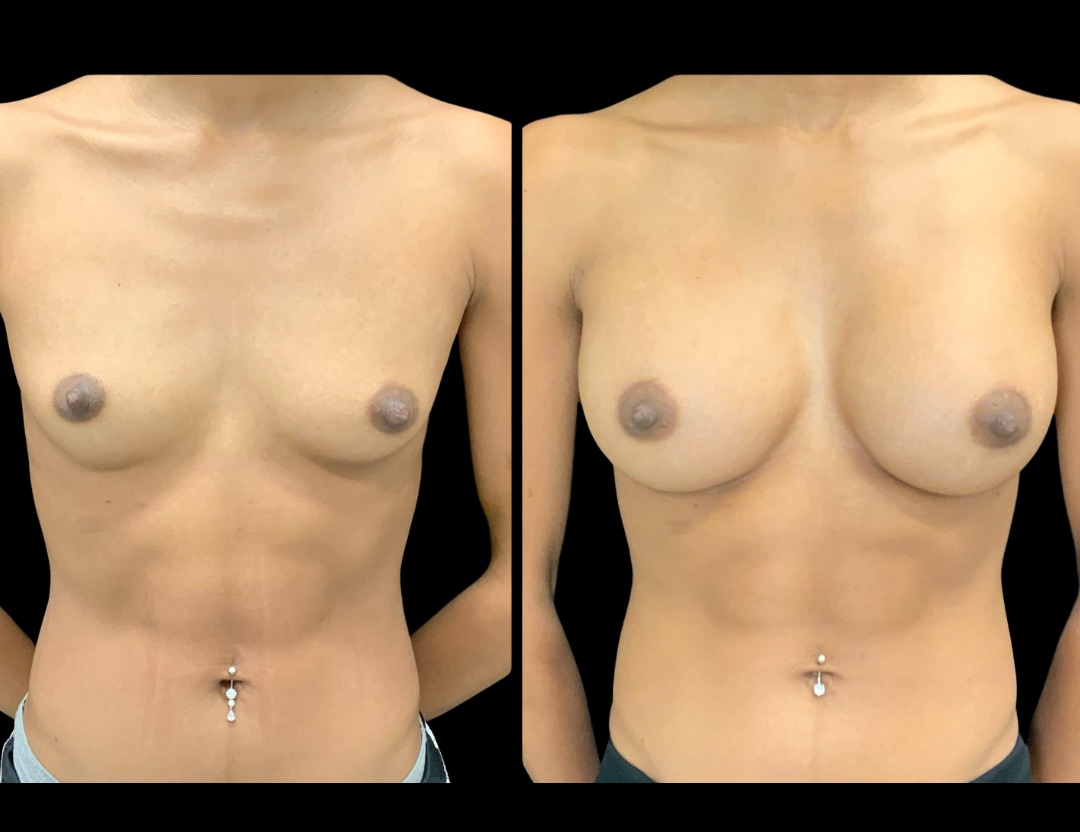 37735 breast aug female before and after – 1