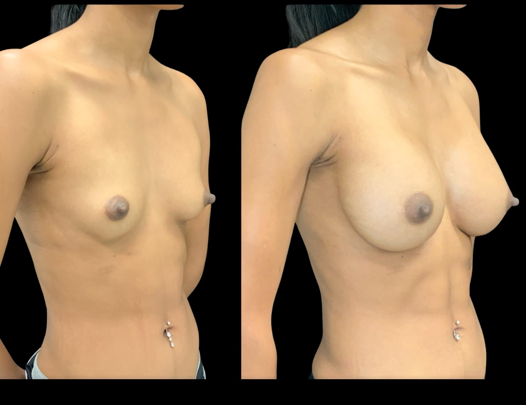 37735 breast aug female before and after – 2
