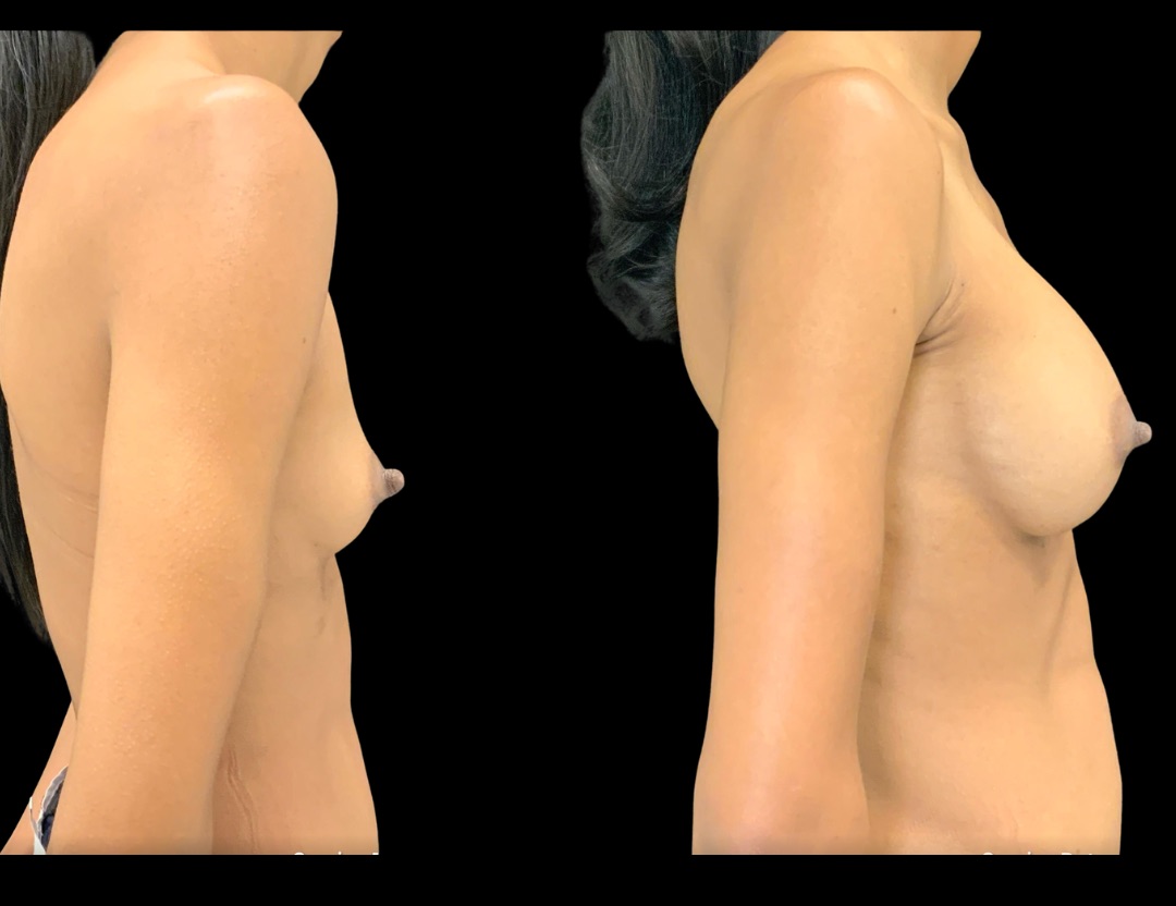 37735 breast aug female before and after – 3