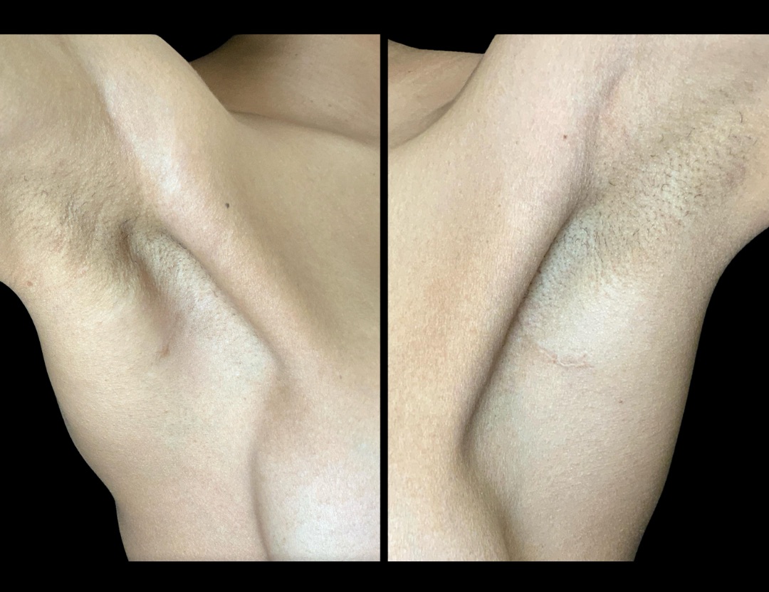 37735 breast aug female before and after – 4