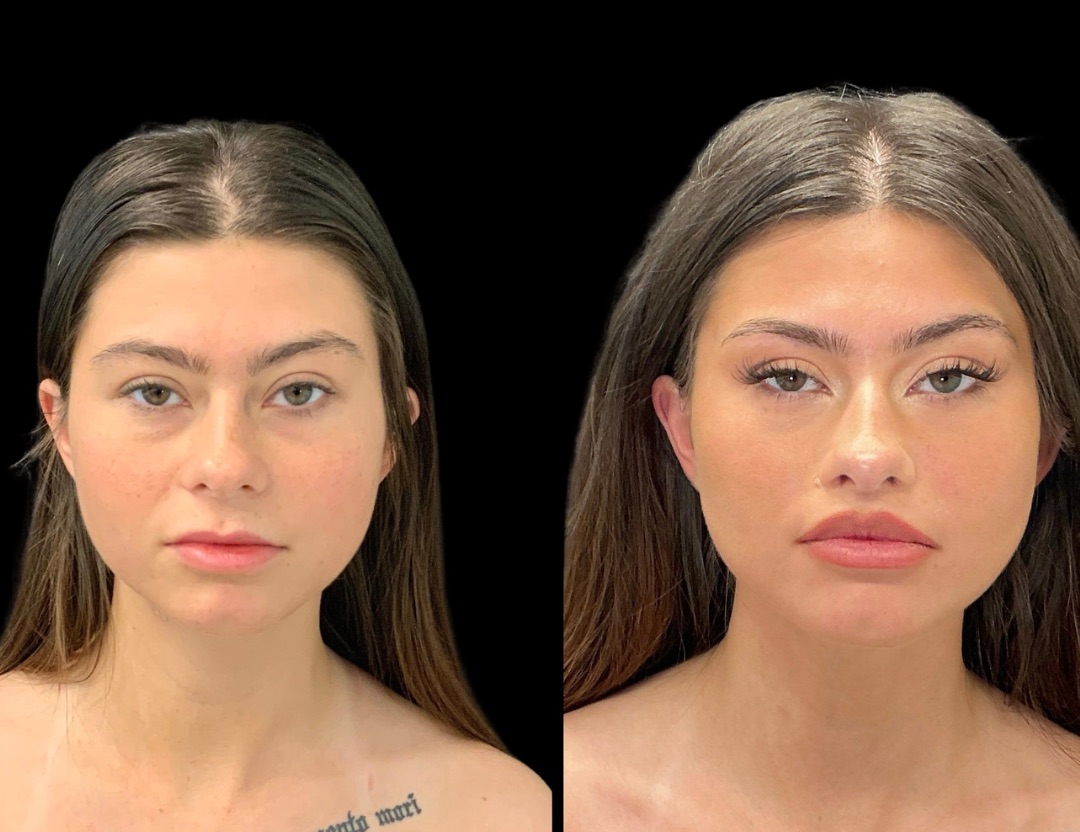 38418 lip lift female before and after – 1