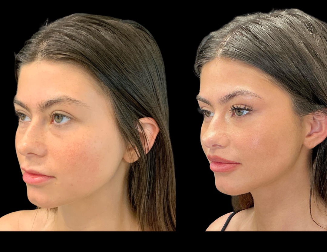 38418 lip lift female before and after – 2
