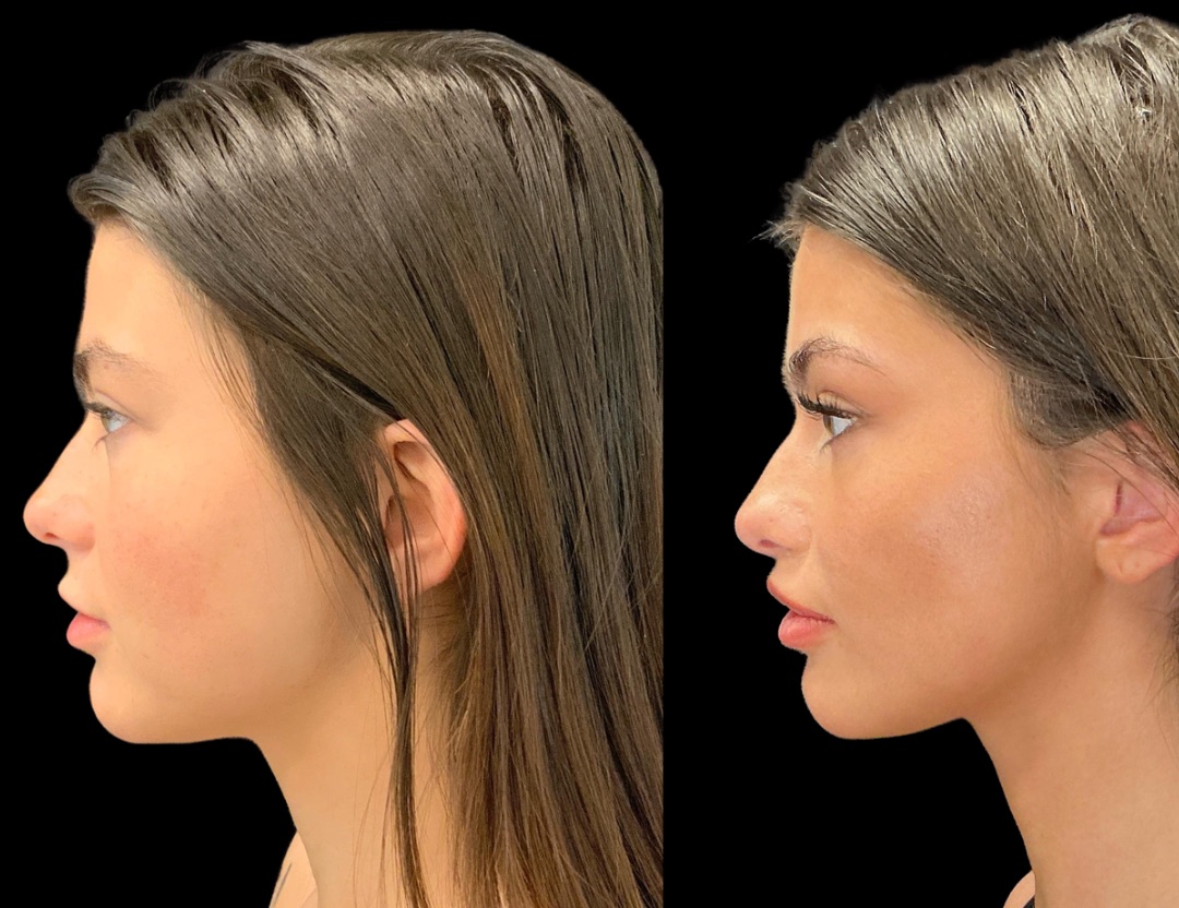38418 lip lift female before and after – 3