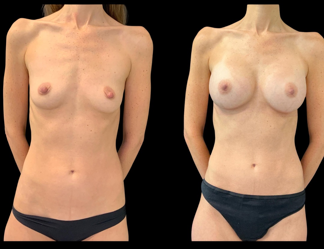 38420 breast aug female before and after – 1