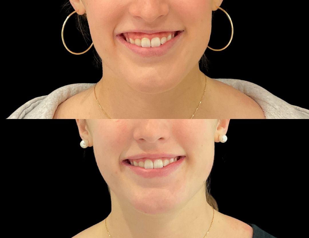 38786 gummy smile female before and after