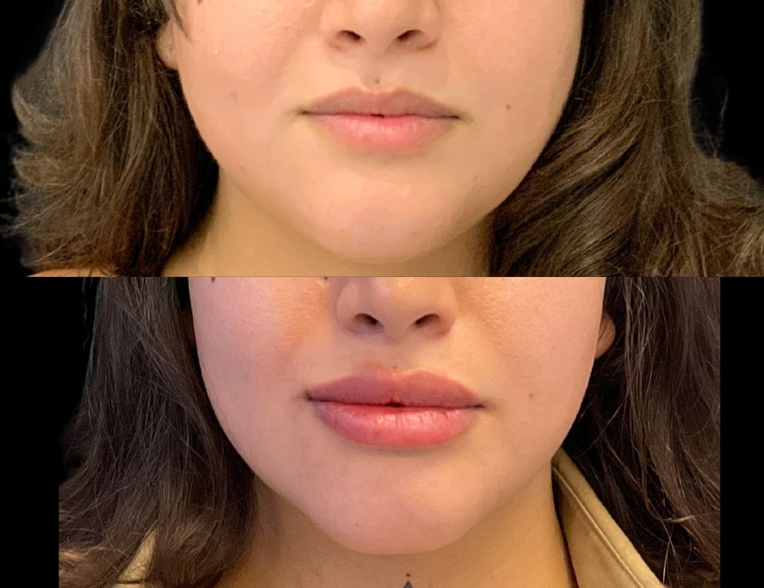38810 lip filler female before and after