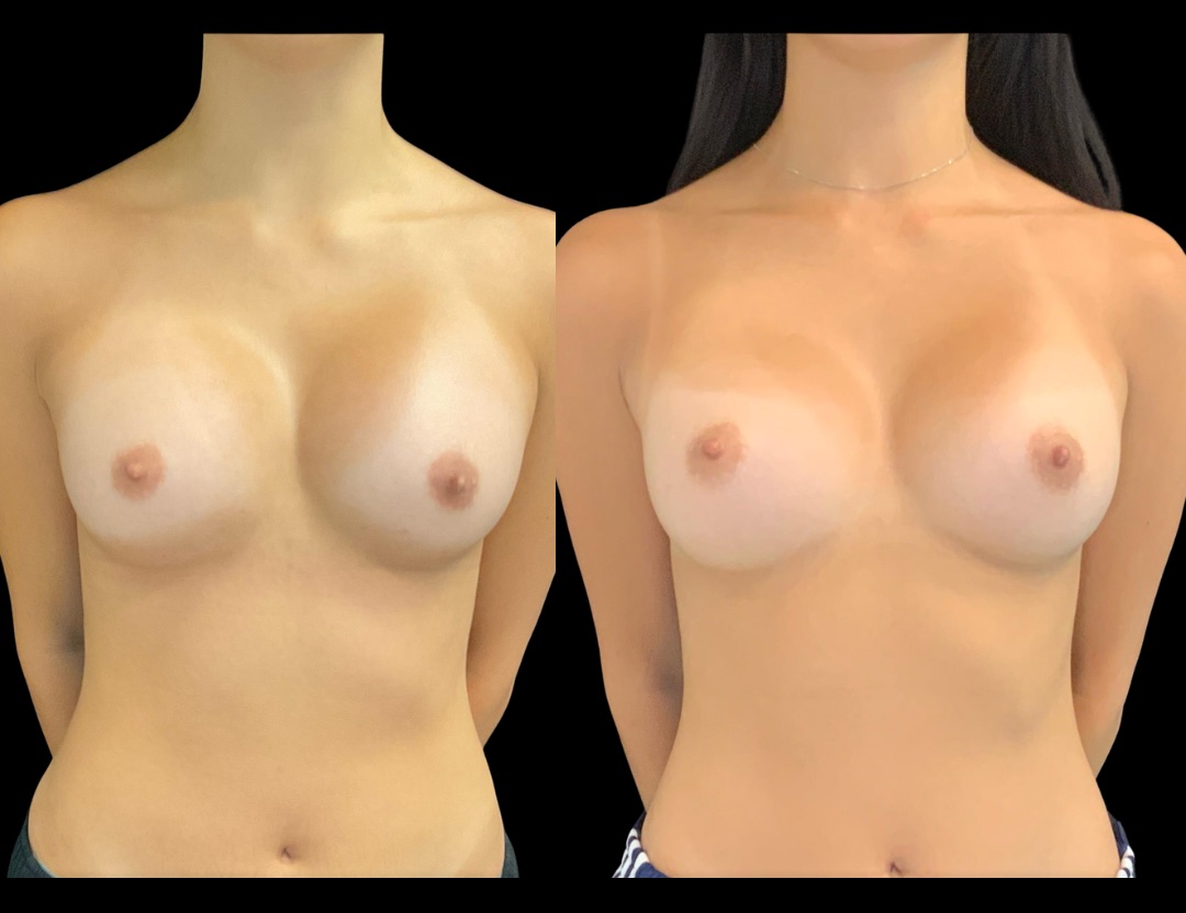 Copy of 37547 rhinoplasty male before and after – 1